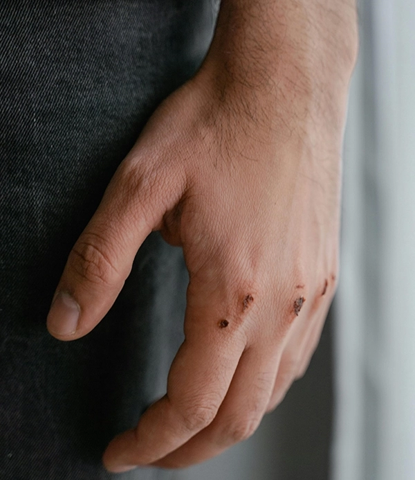 injuries caused by pedestrian collisions